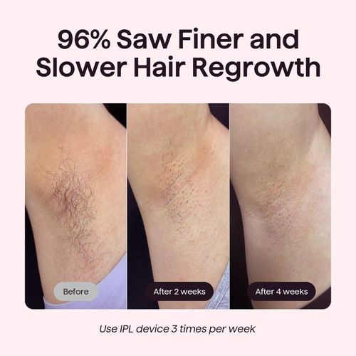 Bare It Without Roller